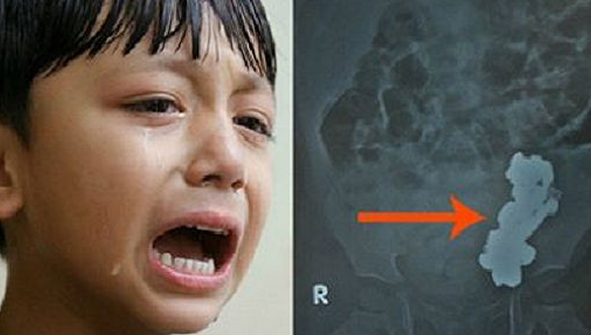 Copilul se plângea de dureri de stomac. Medicul a fost stupefiat la ecografie. Ce avea, de fapt