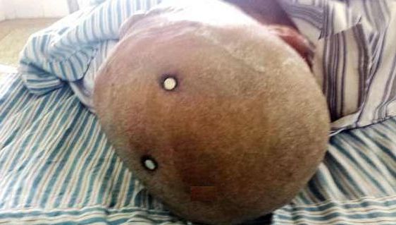 A intrat în comă, după ce şi-a bătut două cuie în cap. Motivul este ULUITOR