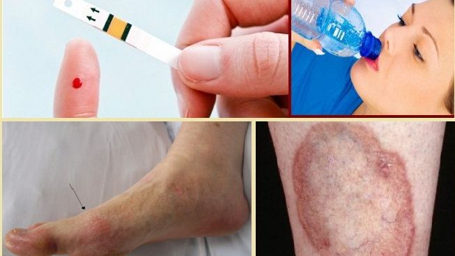 Aşa apare DIABETUL. Patru simptome pe care toată lumea le ignoră