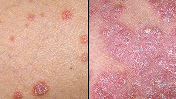 Planta miraculoasă care tratează psoriazisul, eczemele, dermatita şi alergiile pielii