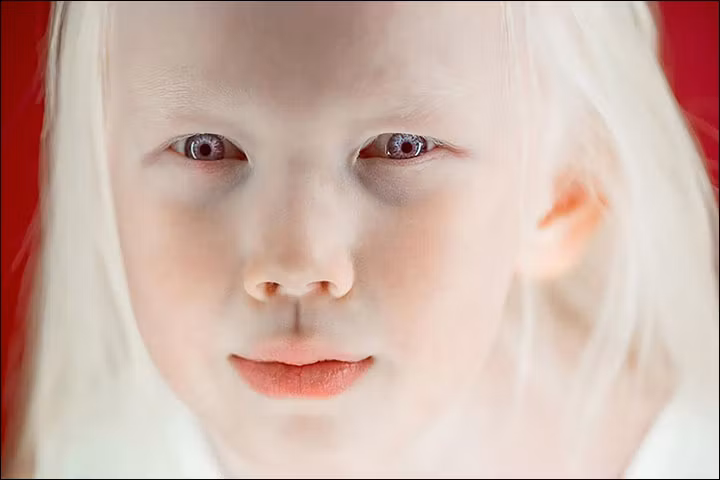 Fetița de 8 ani din Siberia care face senzație pe Internet. Boala rară a transformat-o în "porțelan"