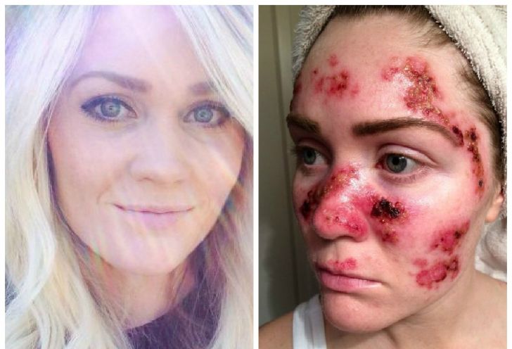 Stătea frecvent la bronzat, până i s-a întâmplat asta. Acum are un sfat pentru întreaga lume