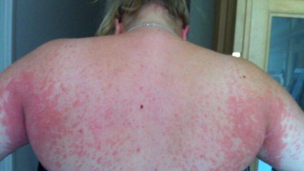 ȘOCANT! Medicii susțin că e cel mai grav caz. Ce a pățit această femeie alergică la propriul copil  