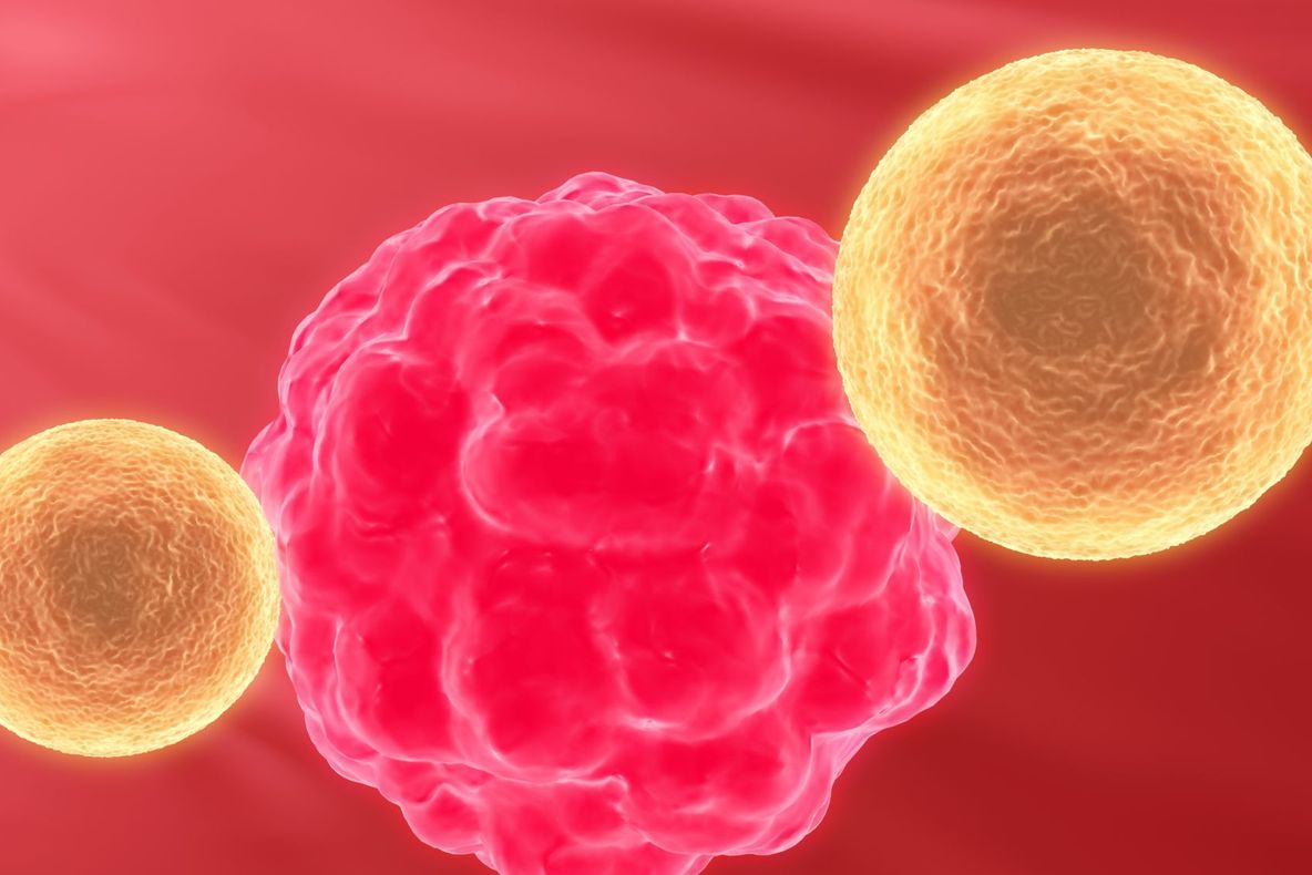 Ce trebuie să știi despre cancerul de pancreas