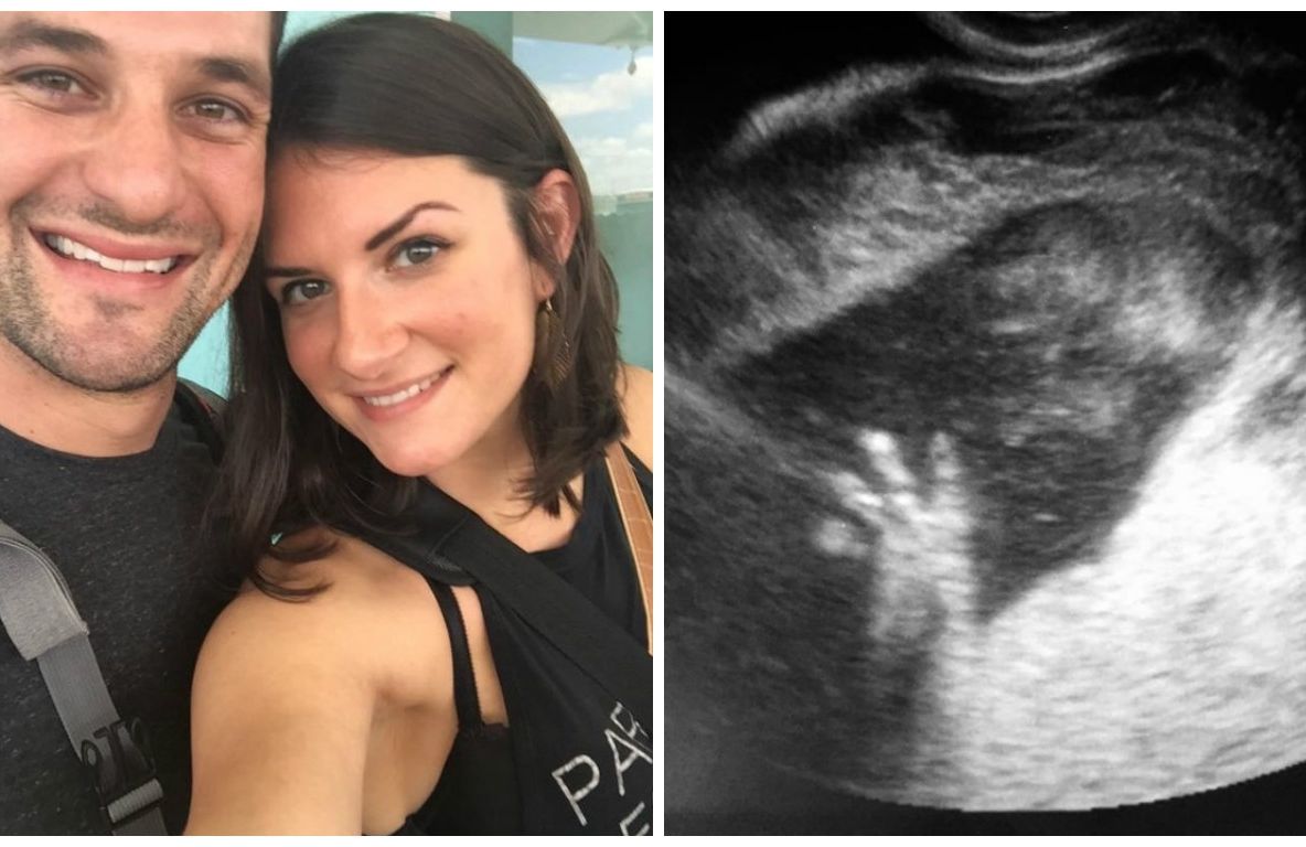 A avortat în luna a 6-a de sarcină și a fost susținută de milioane de oameni. Motivul e șocant