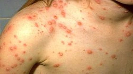 Zece cazuri noi de rujeolă confirmate în Vaslui. În toate cazurile, copiii nu au fost vaccinaţi