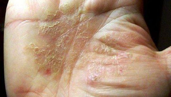 Ţi-a apărut aşa ceva în palmă? Iată ce este şi cum poţi scăpa de ea