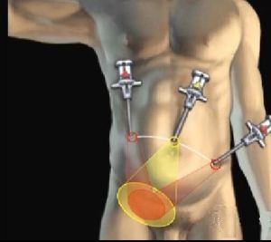 Hernia inghinală. Cât de periculoasă poate fi. Când trebuie operată urgent