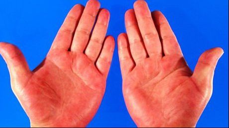 Aceste boli se "citesc" în palmă. La ce trebuie să fii atent
