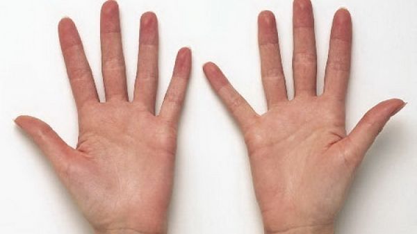 Tot ce trebuie să știți despre psoriazis, afecțiunea care lovește când nu te aștepți