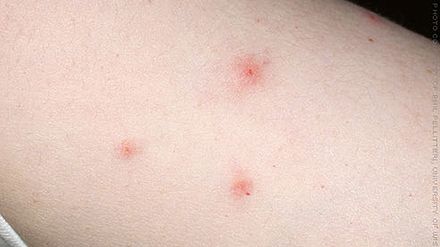 Patru insecte care te pot ucide cu înţepăturile lor! Mergi de urgenţă la medic dacă îţi apar semne