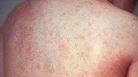 Primele simptome ale RUJEOLEI la adulți. Mergi de urgență la doctor!