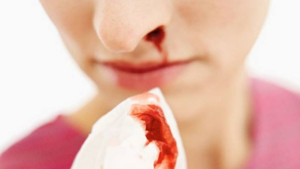 Îţi curge sânge din nas? Nu mai ţine capul pe spate! Poate fi letal