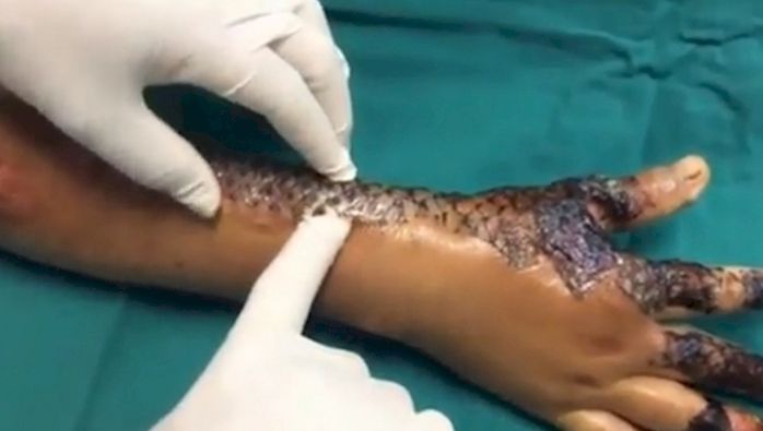 Tratament neconvenţional pentru arsurile de piele. Descoperire revoluţionară a brazilienilor