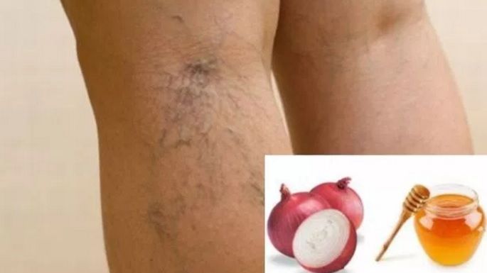 Remediul din două ingrediente care te ajută să scapi de varice DEFINITIV