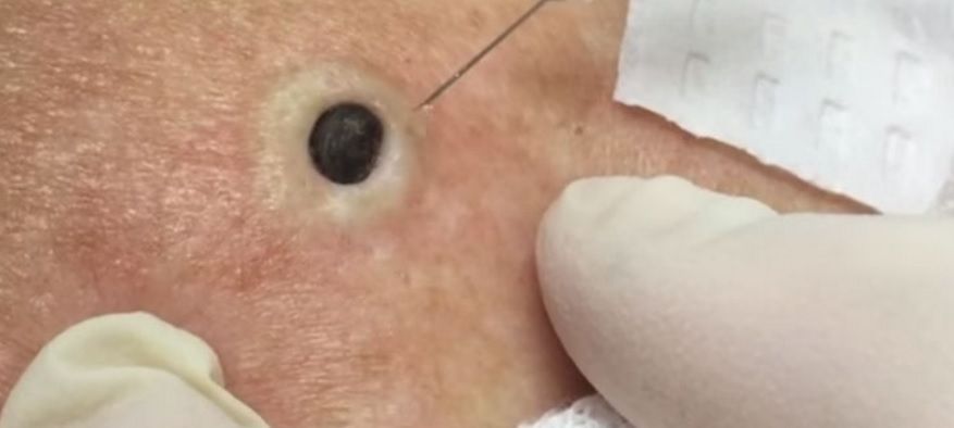 Are 85 ani, toată viaţa a crezut că e o aluniţă pe spate. Doctorul i-a zis ce e, UIMITOR ce a ieşit 