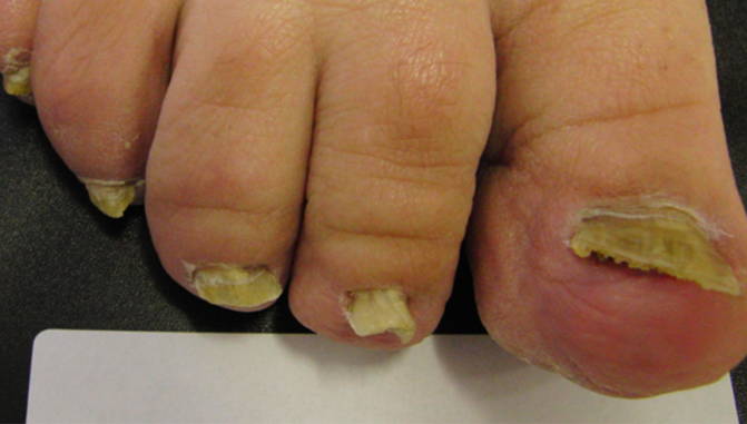 Cum poţi scăpa de ciupercile unghiilor chiar la tine acasă. Foloseşte acest remediu natural