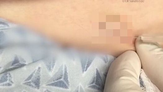 S-a dus la medic cu o umflătură lângă buric. Medicul a înţepat-o cu un ac până a pocnit! ORIBIL