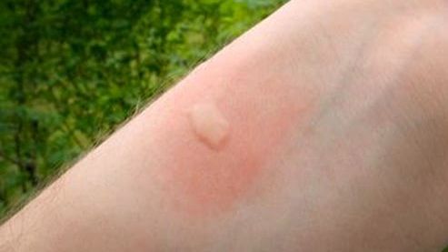 Persoanele care mănâncă asta nu sunt înțepate de țânțari