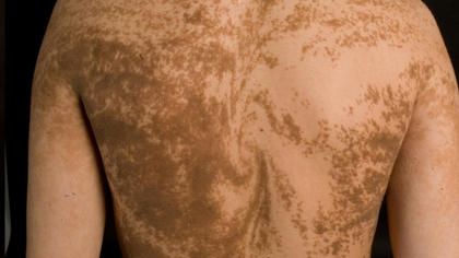 Mult timp au fost considerați ciudați, dar ei sufereau. Care sunt cele mai bizare boli din lume 