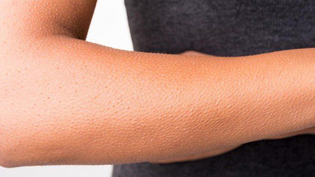 De ce boală poți să suferi, dacă ți se face des pielea de găină