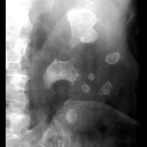 Cum îndepărtezi pietrele la rinichi. Acest amestec natural, cea mai simplă metodă