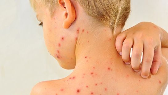 Rujeola face RAVAGII în România