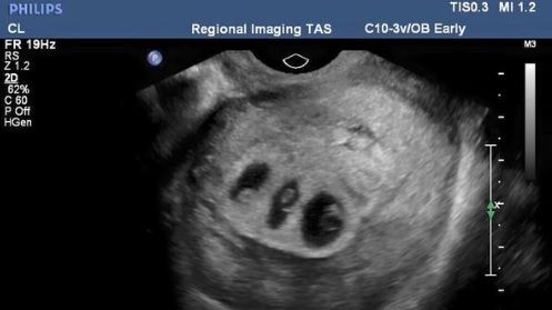 Doctorii i-au spus să aleagă care dintre cei 3 bebeluşi va trăi. Decizia ei a şocat o lume întreagă!