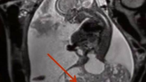 Au mers la medic să afle sexul copilului, dar s-au îngrozit când au văzut ce avea femeia în burtă