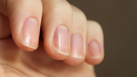 Unghiile tale îți arată dacă ai acest tip de cancer! Mare atenție la semnele corpului