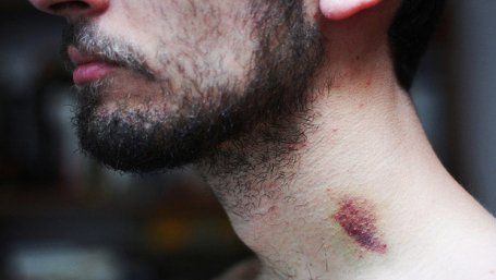 Un tânăr a murit după ce iubita l-a sărutat pătimaş pe gât! Ce au descoperit medicii