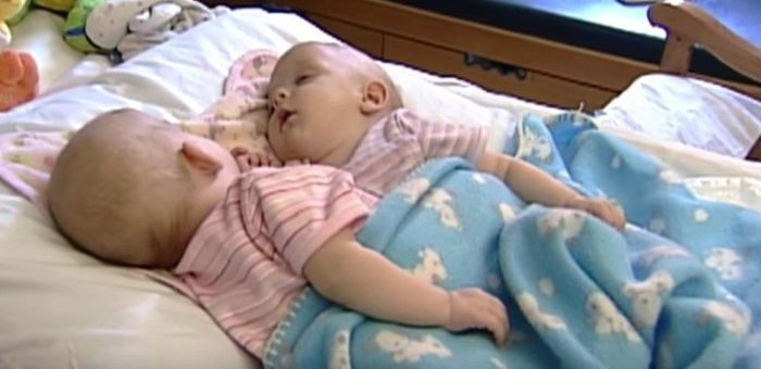 Acum 10 ani, doctorii au încercat să separe cele două siameze. Cum arată fetițele acum. E tulburător