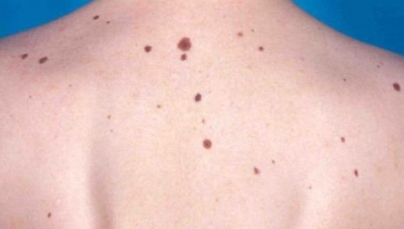 Semnele de alarmă care anunță cancerul de piele