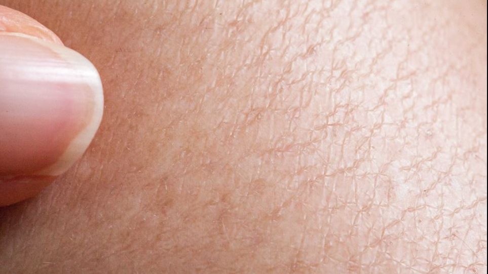 Ai acest semn pe piele? Ia măsuri! Riști să ai probleme cu colesterolul