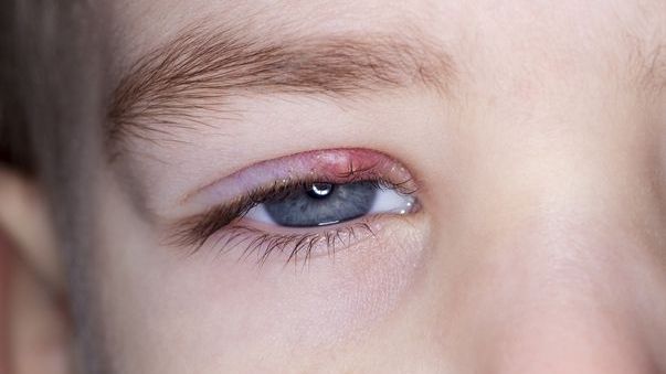 Cum poți scăpa rapid de ulcior prin metode simple