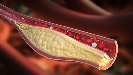 Așa îți dai seama că ai arterele înfundate. Simptome care anunță că ești în mare pericol