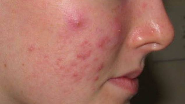 Cum îţi dai seama că ai acnee hormonală