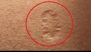 Toată lumea are această cicatrice ciudată, dar puțin știu despre ce e vorba cu adevărat