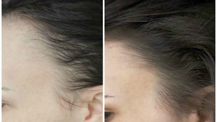 Începuse să chelească și intrase în panică, așa că s-a hotărât să încerce un tratament 