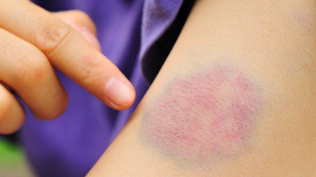 De ce apar vânătăi atunci când o persoană suferă de leucemie? Simptomele ascunse