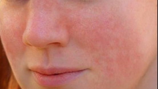 Semnele că vei face o boală autoimună