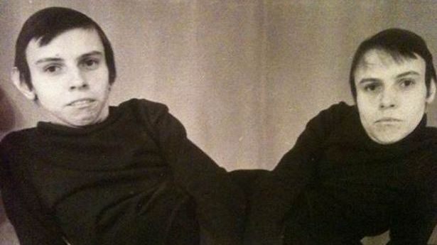 Povestea EMOȚIONANTĂ a siamezelor Masha și Dasha. Au fost torturate ca-n Evul Mediu...