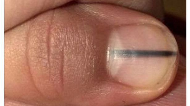 Credea că e o pată banală sub unghie, dar i s-a spus să meargă la doctor. Avea o boală cumplită 