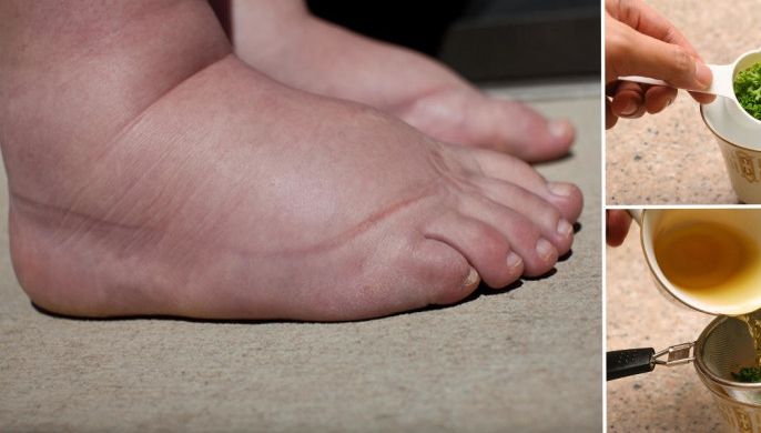 Adio, picioare umflate! Iată cel mai puternic leac pentru această afecțiune 