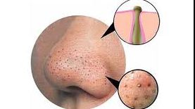 Metoda simplă să scapi de puncte negre 