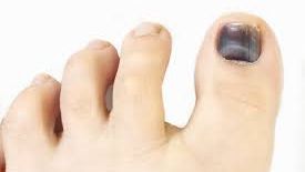Atenție! Unghia neagră de la picior poate ascunde o boală gravă