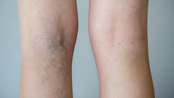 Chirurgul vascular Rafael Halpern, despre pericolul varicelor: "Cele mai afectate sunt femeile"