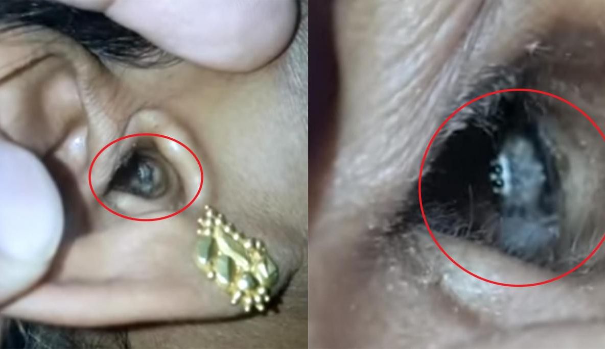 S-a dus la doctor cu o durere de cap. Medicii au rămas șocați când au văzut ce are, de fapt