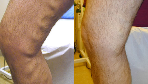 Verifică şi tu dacă suferi de TROMBOZĂ VENOASĂ. Completează online chestionarul