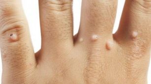 Cum să scapi de negi fără bisturiu? Soluția miraculoasă la care nu te-ai fi gândit 